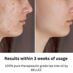 Tea Tree Essential Oil