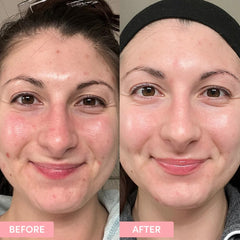 Pore Minimizing Bundle By Dr. Bisma